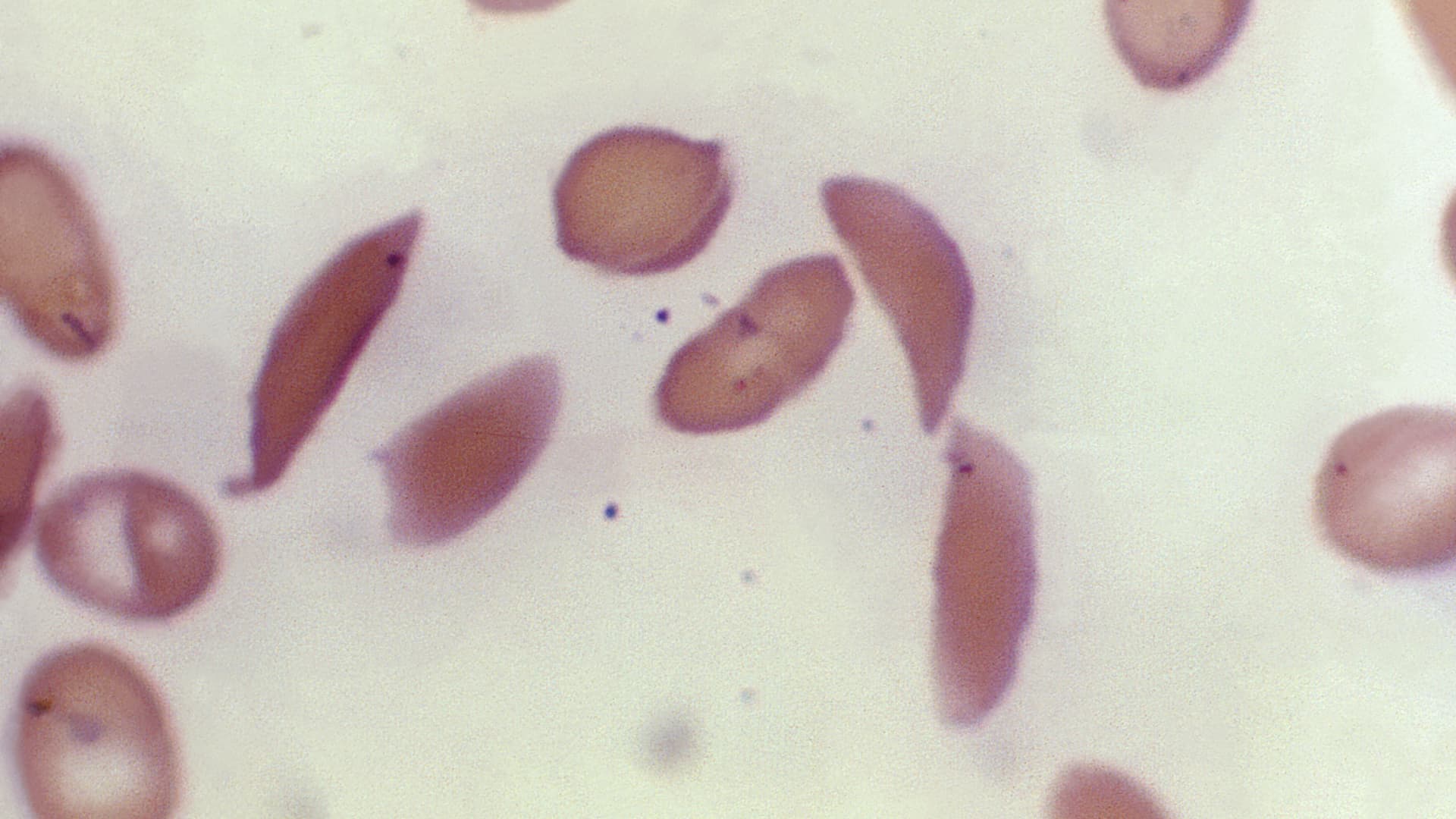 U.S. approves first gene-editing treatment, Casgevy, for sickle cell diseaseU.S. approves first gene-editing treatment, Casgevy, for sickle cell disease