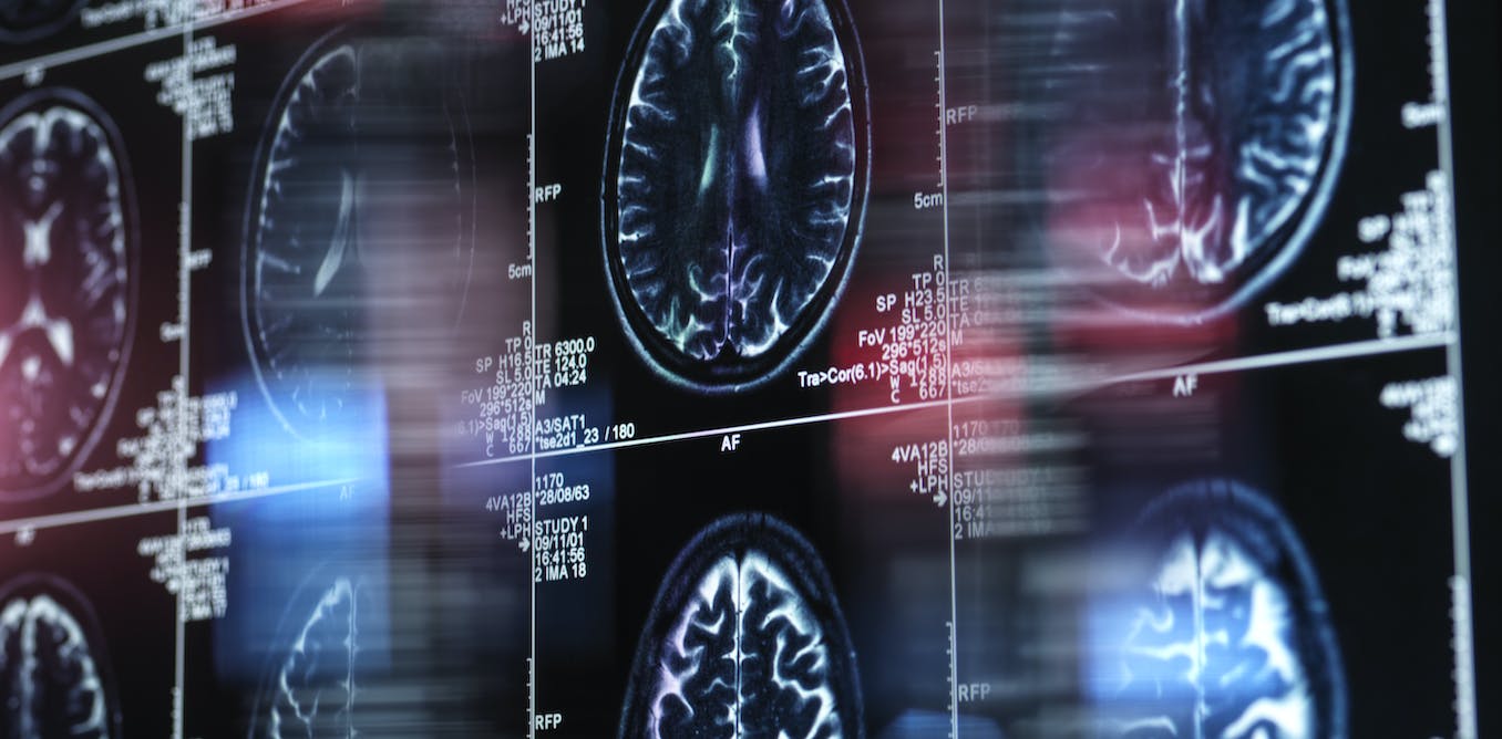 Alzheimer’s disease is partly genetic − studying the genes that delay decline in some may lead to treatments for allAlzheimer’s disease is partly genetic − studying the genes that delay decline in some may lead to treatments for all